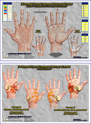 3-Phase Hand Reflex Therapy Charts